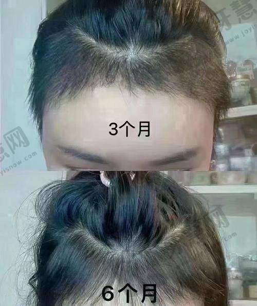 佛山雍禾种植毛发医院口碑如何？