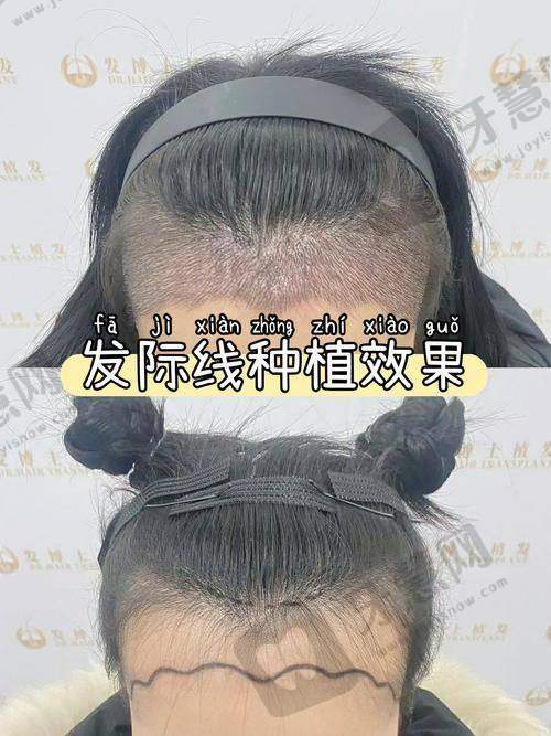 沈阳华美植发医院口碑如何