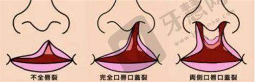 广州广大医院做正颌手术怎样预约医生？2025 年何锦泉医生挂号方式及医院地址公布
