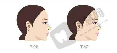 出彩医美十分钟隆胸真的靠谱不是骗局之真实体验与护理