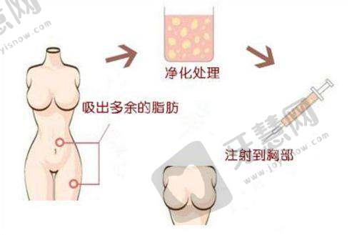 上海隆胸价格及坐诊时间公开：曼托3万/傲诺拉6.8万+医生坐诊时间汇总