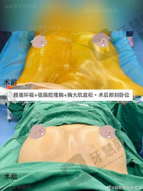 上海华艺星整形张玲医生口碑评价及真人实例