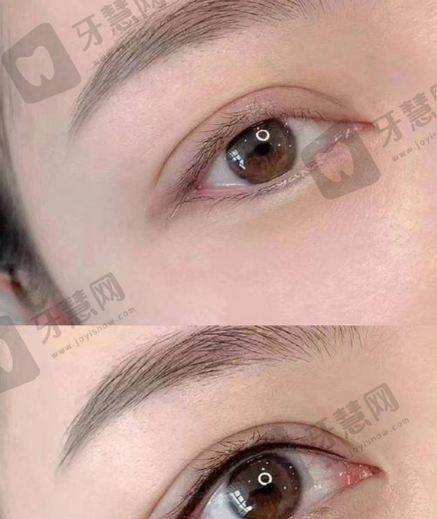 出彩医美十分钟隆胸真的靠谱不是骗局之定制丰胸特色
