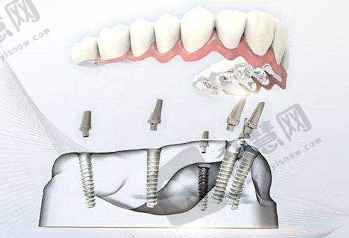 连江维乐口腔的真人实例与口碑评价怎样?