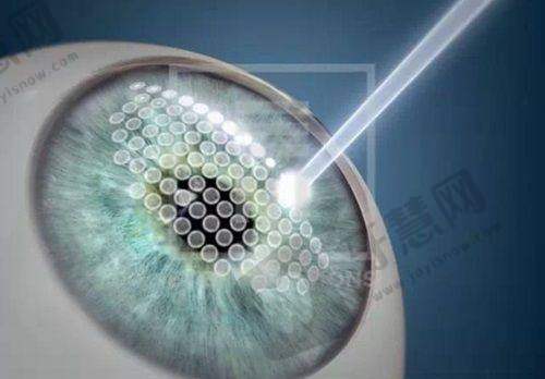 昆明康特森眼科医院二级资质下的擅长领域