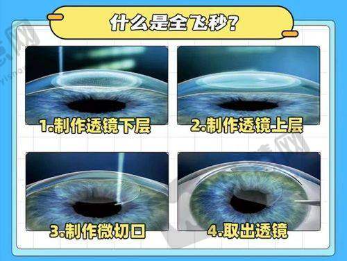 昆明康特森眼科医院二级资质下近视手术的仪器设备优势