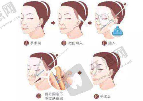上眼脸下垂是什么原因引起的：神经病变因素