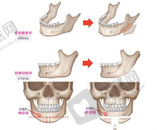 男性三件套手术的成效与注意事项