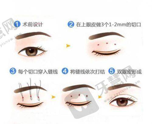 苗春花医生的眼部整形技术优势