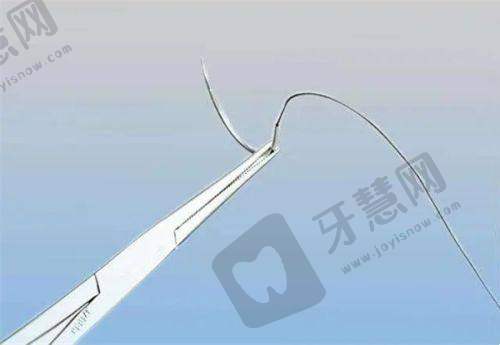 泰国女变男变性手术的费用情况