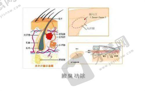男科假体植入多少钱：不同医院的收费情况