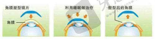 七、河南省人民医院眼科角膜塑形镜收费情况