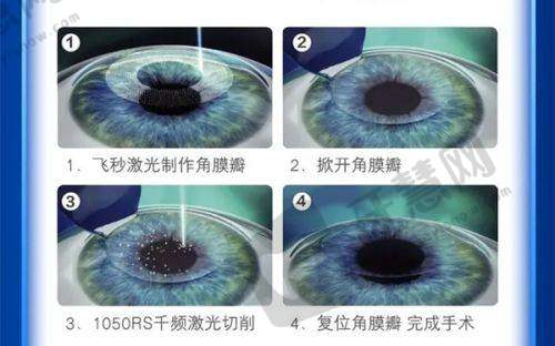 上海新视界和爱尔眼科晶体植入哪个好:晶体植入实力较量