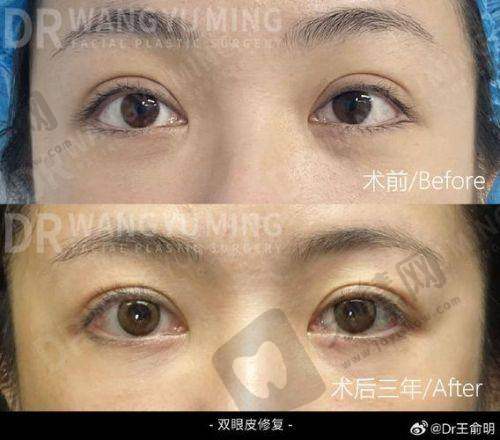 顾客对苗春花医生的眼部整形好评