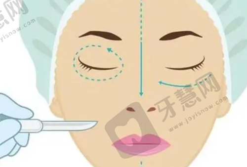 上海伯思立双眼皮整形技术成效怎么样？用户体验反馈为证