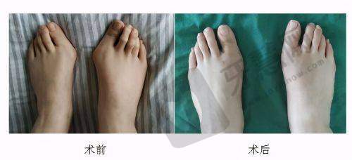 选择西安高一生眼部整形的优势总结