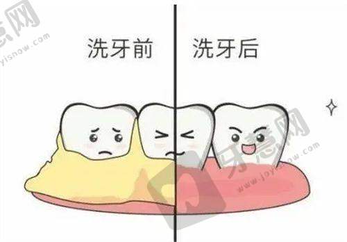 影响牙贴面价格的3大因素（90%的人不知道）