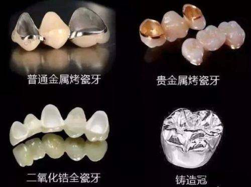 格莱美全瓷牙与威兰德全瓷牙材质与强度解析