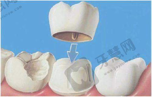 美加瓷贴面什么档次？定位中高端国产标杆，对比进口品牌有何优势