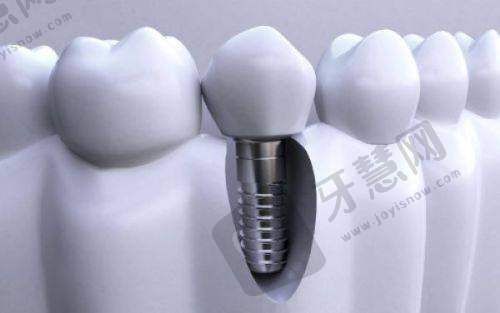 牙齿活动了更好的处理方法——2025年全新价格参考：不同修复方式要花多少钱？