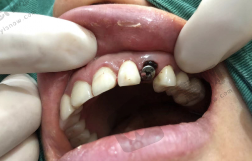 牙贴面十年后脱落真实图片中的典型症状