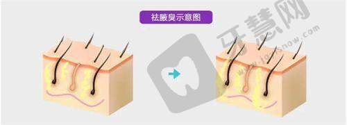 五、丽都医美研究画缇骨胶原能维持多久