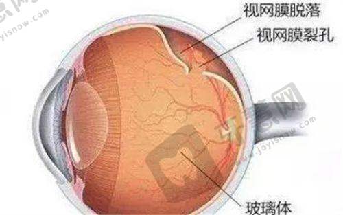 亲历北京茗视光眼科医院全飞秒:手术前后生活的变化