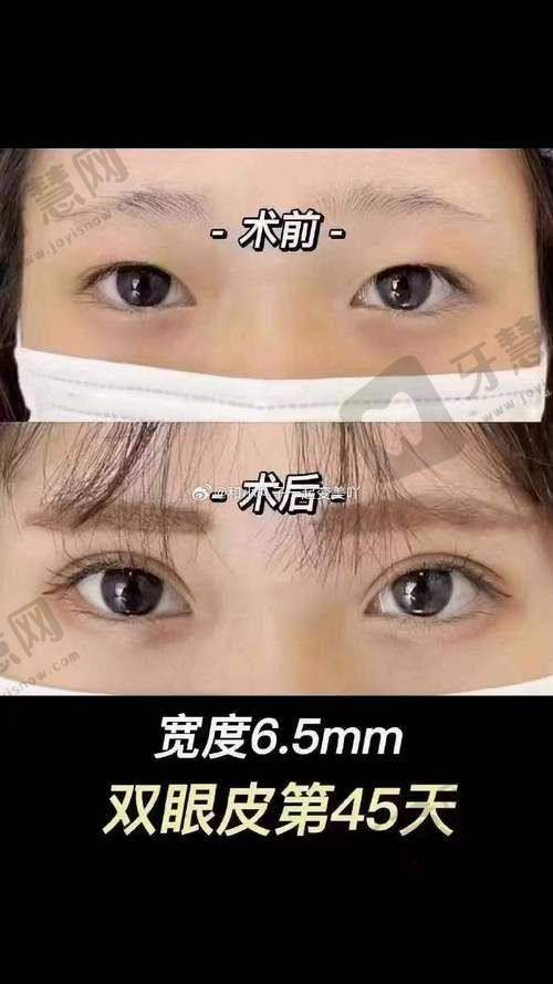 总结：上海伯思立医疗美容医院双眼皮整形项目值得选择