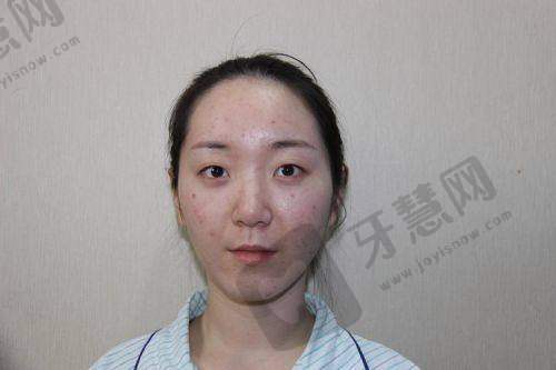 双眼皮手术种类丰富，满足不同需求
