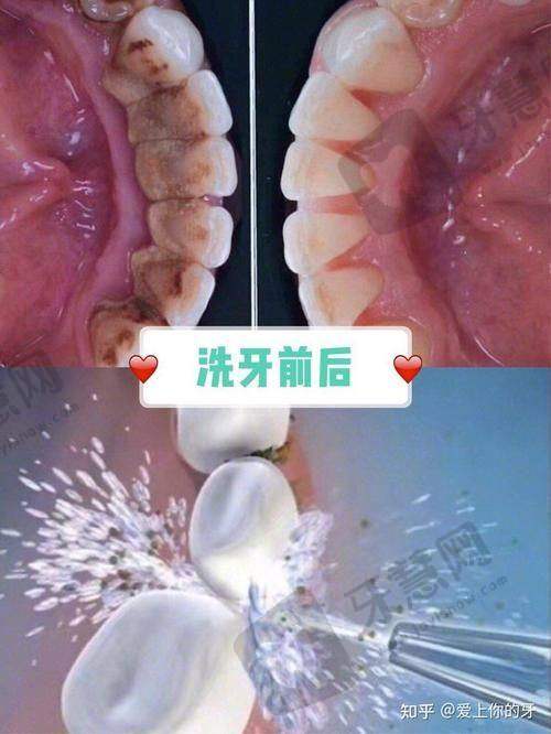 牙齿做贴面多少钱2025？树脂/铸瓷/蓝瓷价差大！门牙后牙价目表：800-5000元一颗？