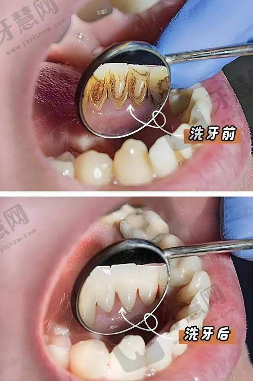 口腔科热门项目价格参考：种植牙/矫正费用一文读懂