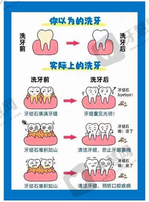 牙贴面大概多少钱一颗2025？瓷/树脂贴面800-6000元，含品牌价格表及避坑指南！