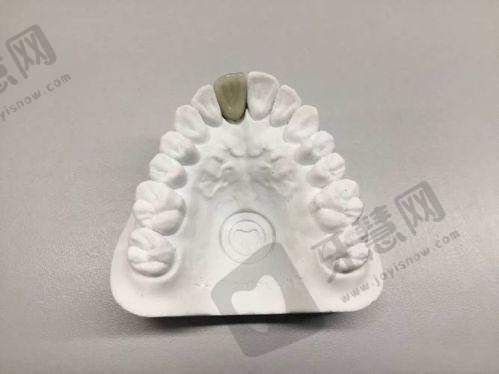 牙齿贴片的缺点和潜在危害:这些“坑”你必须知道