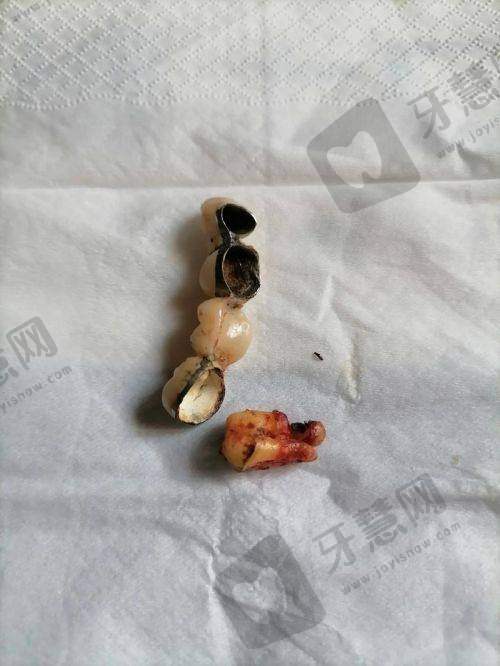 牙齿贴片和烤瓷牙的区别：谁对牙齿损伤更大？