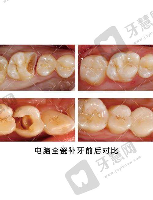 格莱美全瓷牙价格避坑指南：这3类费用要警惕
