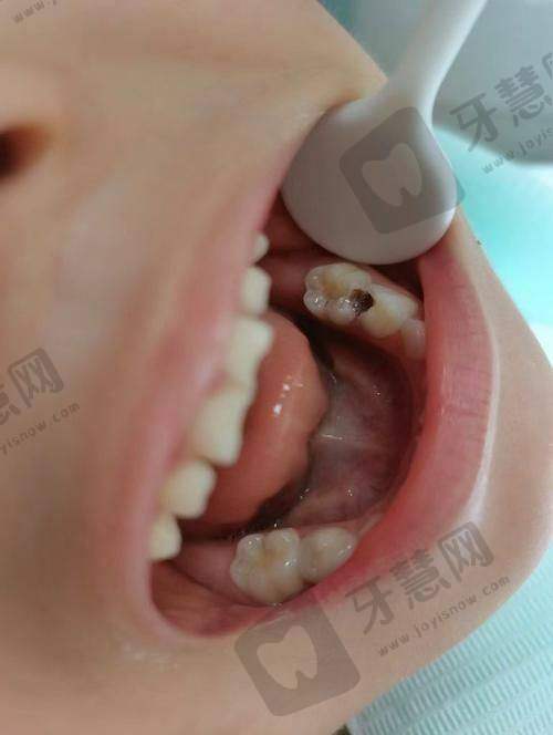 西诺德全瓷牙真实用户实例：20年使用体验分享