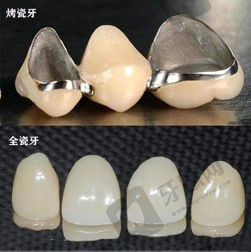 西诺德全瓷牙使用寿命多久？做好3件事延长到20年+