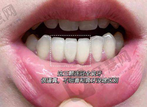 西诺德全瓷牙好不好：临床实例告诉你真实体验