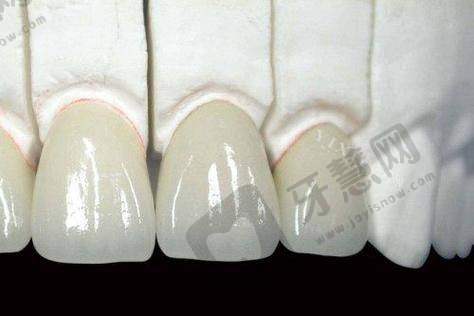 总结：美国3M拉瓦全瓷牙——高端修复的理性选择