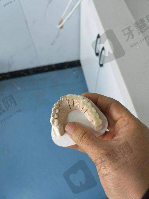 西诺德全瓷牙4500元值不值得做？—— 3类人群的