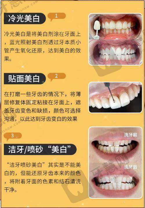易美和义获嘉其他系列有何区别？为什么它更适合前牙美学修复？