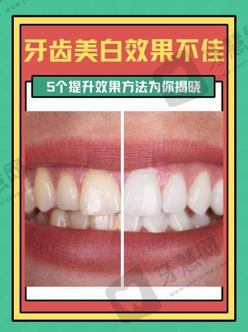 美加全瓷贴面适合哪些人？3类人群适配度高，这类情况不建议做