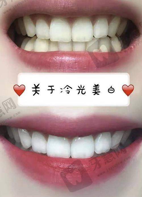 美加全瓷贴面价格表2025：单颗多少钱？全口16颗要花多少？
