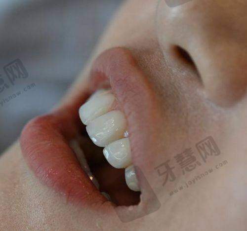 贴瓷片牙避坑指南：这5种情况千万别做，否则白花冤枉钱！