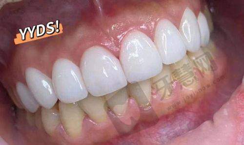 总结:美加全瓷贴面哪个系列更好?关键看这3点