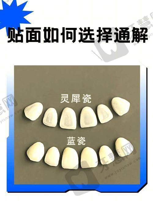 美加瓷贴面真实实例：32岁四环素牙患者的“焕牙”经历