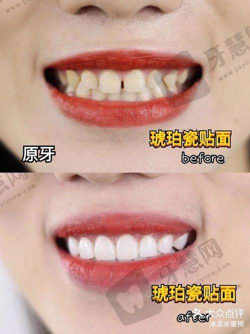 贴瓷片牙对牙齿有伤害吗？磨牙多少才算安心？