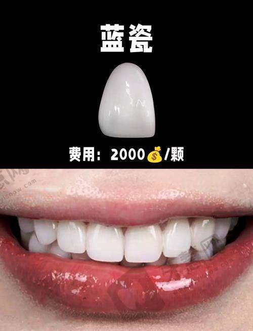 国产vs进口贴面牙齿价格多少钱一颗?——差价在哪里