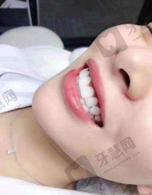 贴瓷片牙价格差3倍！材料和地区哪个影响更大？