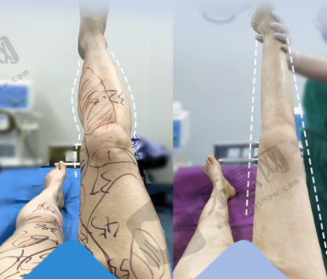 西安高一生隆鼻医生怎么样？